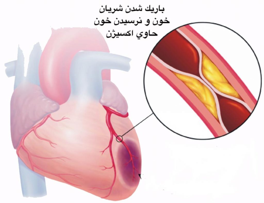 بیماری عروق کرونر قلب