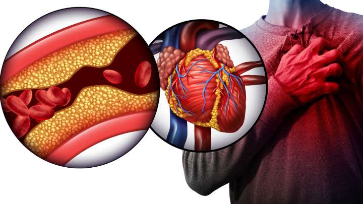 خطرات ناشی از گرفتگی رگ قلب