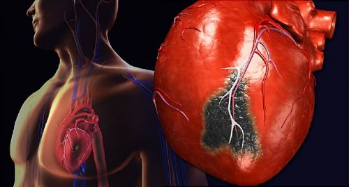 نارسایی وریدی و آسیب دیدگی دریچه های قلب