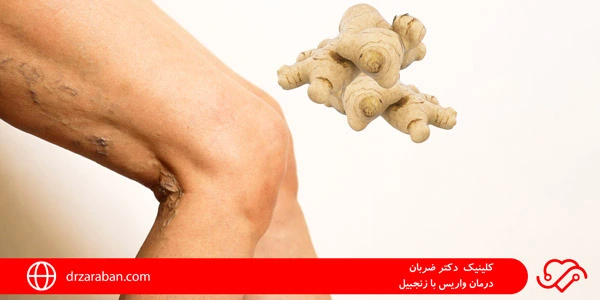 Treatment-of-varicose-veins-with-ginger-1