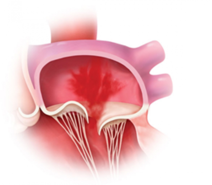 درمان افتادگی دریچه میترال